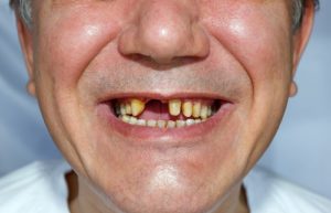 Five Habits that Can Ruin Your Teeth